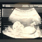 Ultrasound Keepsake Photo
